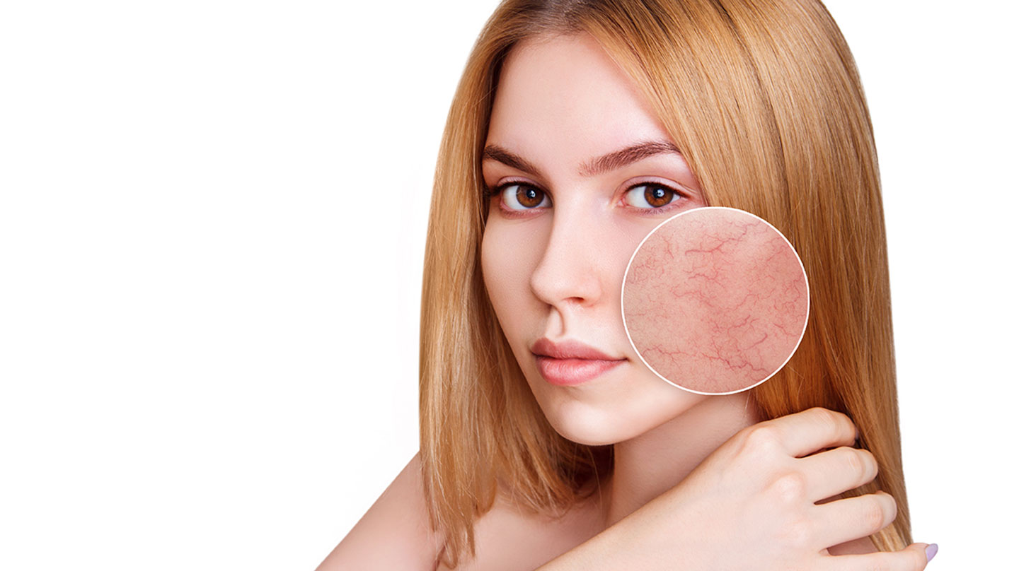 Rosacea: gerötete Haut besänftigen Rosacea erkennen und behandeln