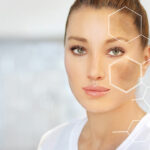 Pigmentflecken verblassen lassen