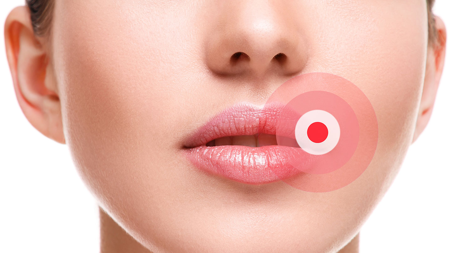 Lippenherpes – wenn's kribbelt, schnell reagieren Was bei Lippenherpes hilft